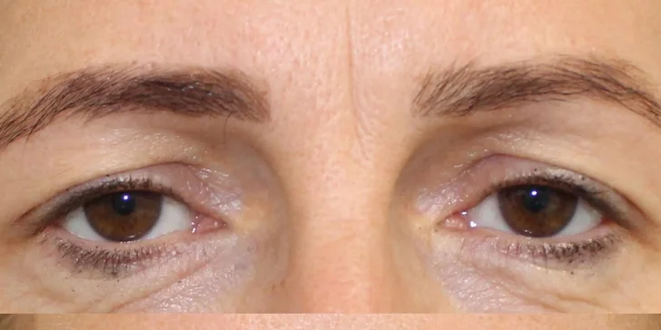 Lifting čela a viečok: Operácia horných viečok alebo Direct browlift s efektom blefaroplastiky