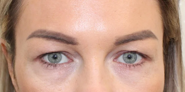 Lifting čela a viečok: Operácia horných viečok alebo Direct browlift s efektom blefaroplastiky