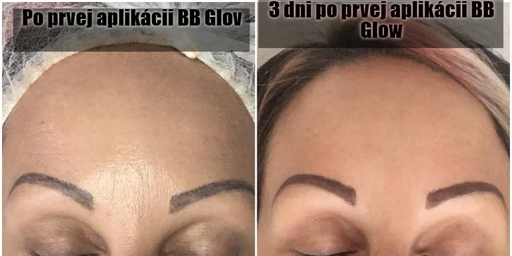 Všetko pre krásnu pleť: Dermabrázia, rádiofrekvencia či microneedling