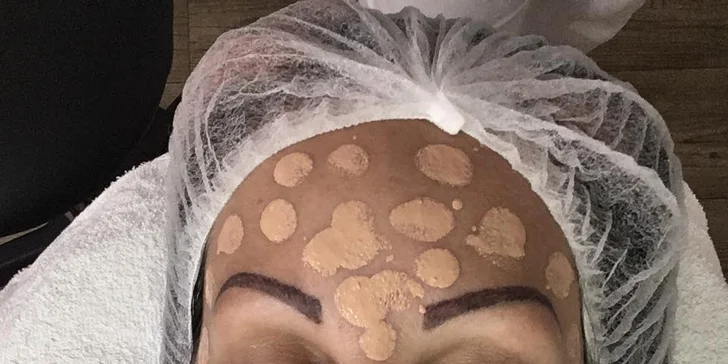 Všetko pre krásnu pleť: Dermabrázia, rádiofrekvencia či microneedling