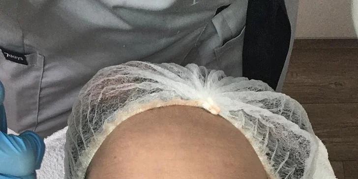 Všetko pre krásnu pleť: Dermabrázia, rádiofrekvencia či microneedling
