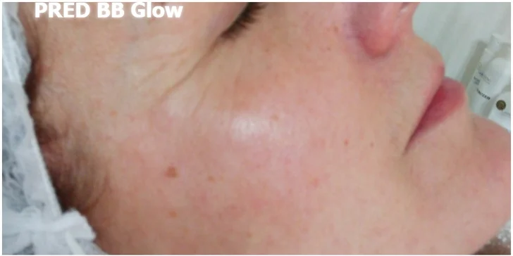 Všetko pre krásnu pleť: Dermabrázia, rádiofrekvencia či microneedling