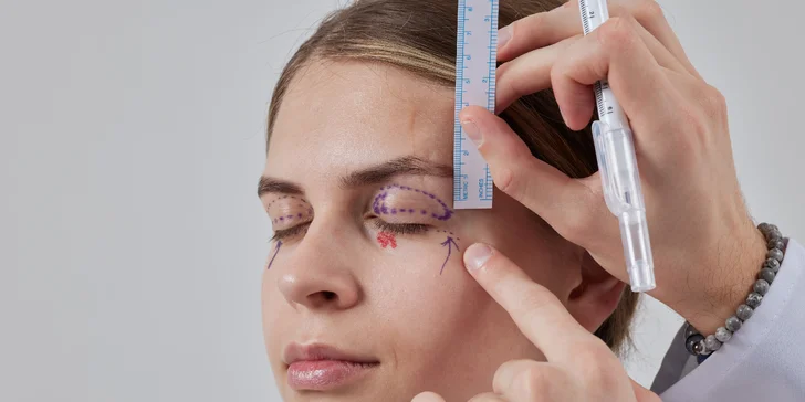 Lifting čela a viečok: Operácia horných viečok alebo Direct browlift s efektom blefaroplastiky
