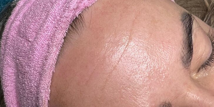 Mezoterapia vlasov či tváre alebo letná regeneračná kúra Mando 40