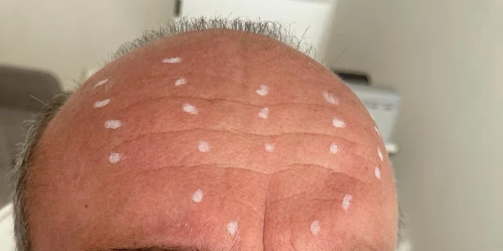 Aplikácia botulotoxínu do oblasti tváre v Neuroderm: Jedna, dve či tri lokality