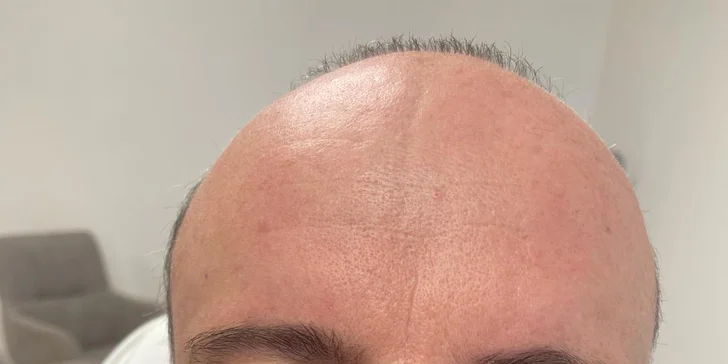 Aplikácia botulotoxínu do oblasti tváre v Neuroderm: Jedna, dve či tri lokality