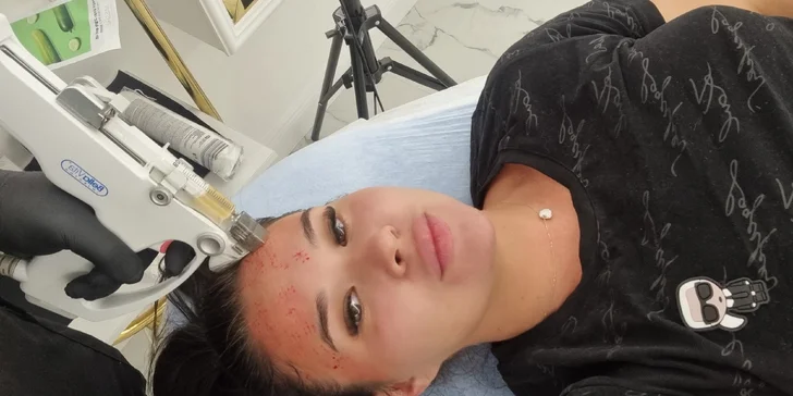 Mezoterapia tváre či vlasov v estetickom centre Esteľ by Dr. Žaneta