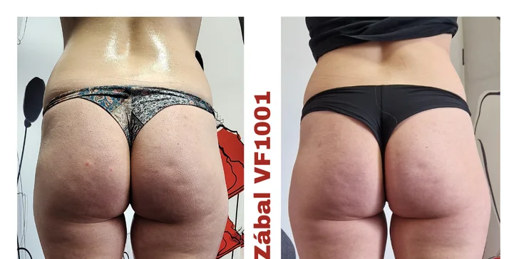 Zoštíhľujúci balíček, zábal Vacuum Fit100 alebo masáž s bankovaním