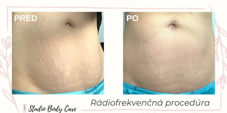 Zoštíhľujúci balíček, zábal Vacuum Fit100 alebo masáž s bankovaním