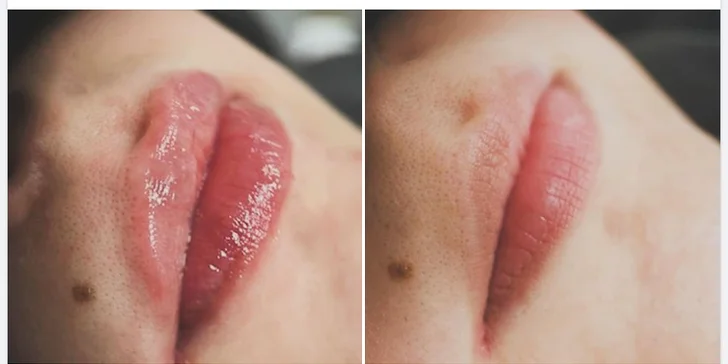 Výplň pier alebo kruhov pod očami či lifting tváre botulotoxínom