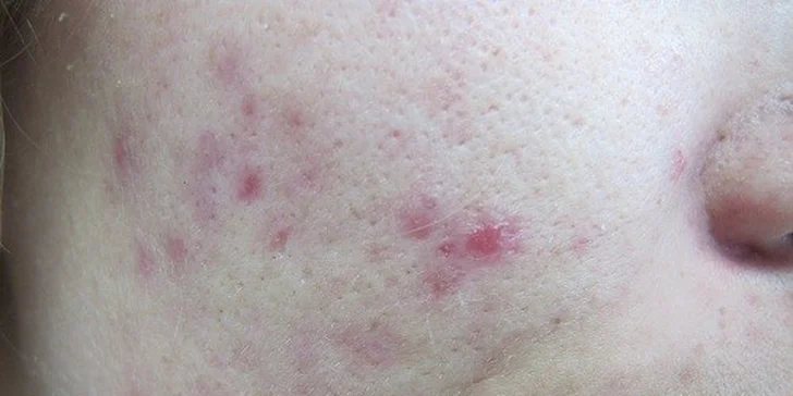 Omladenie pleti v centre plastickej chirurgie