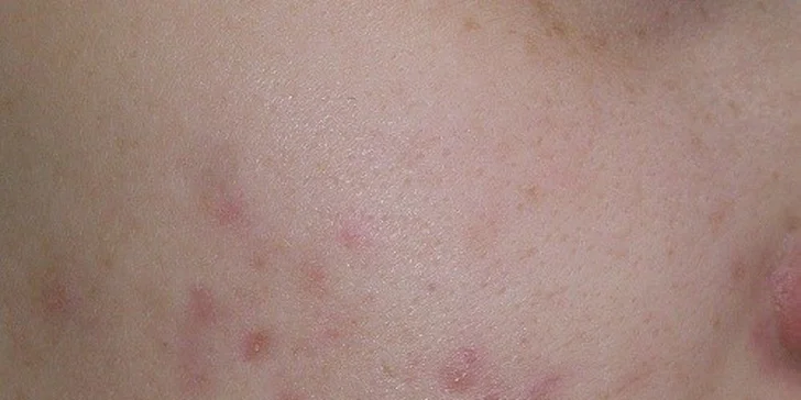 Omladenie pleti v centre plastickej chirurgie