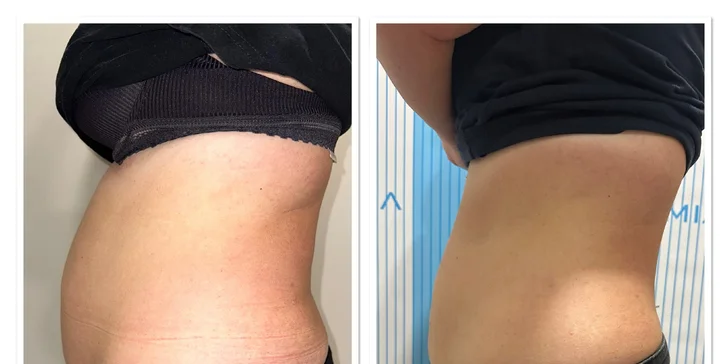 Vyformujte svoje telo a cíťte sa sebavedomejšie vo VERSI beauty lounge v Piešťanoch