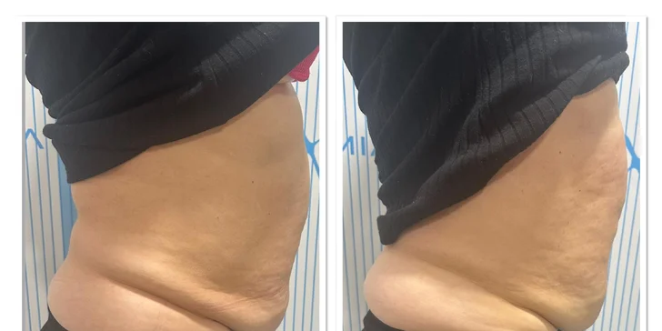 Vyformujte svoje telo a cíťte sa sebavedomejšie vo VERSI beauty lounge v Piešťanoch