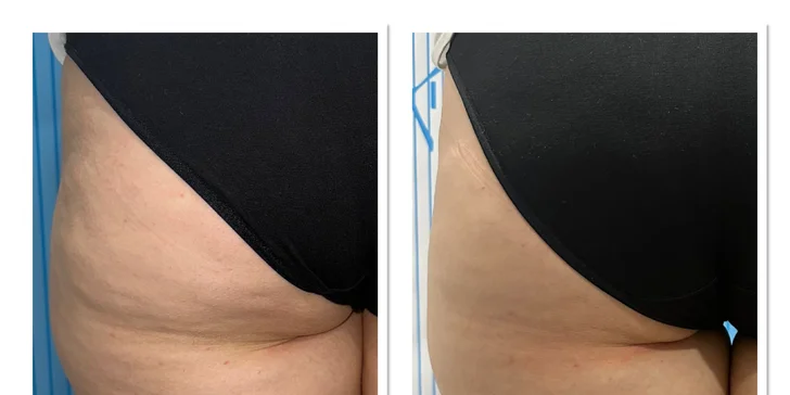 Vyformujte svoje telo a cíťte sa sebavedomejšie vo VERSI beauty lounge v Piešťanoch