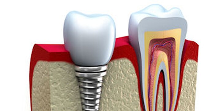 Zľavový kupón na zubný implantát s korunkou