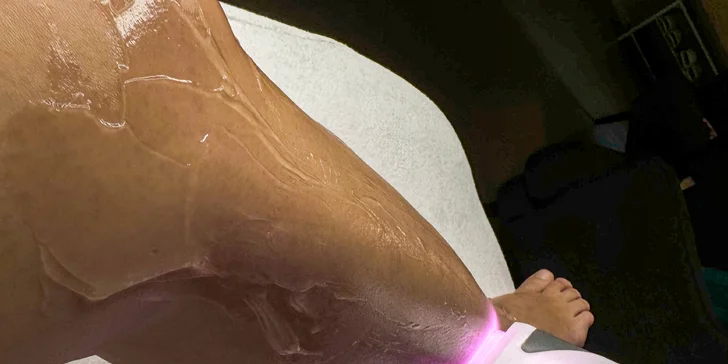 Zbavte sa chĺpkov: Laserová epilácia pre dámy aj pánov