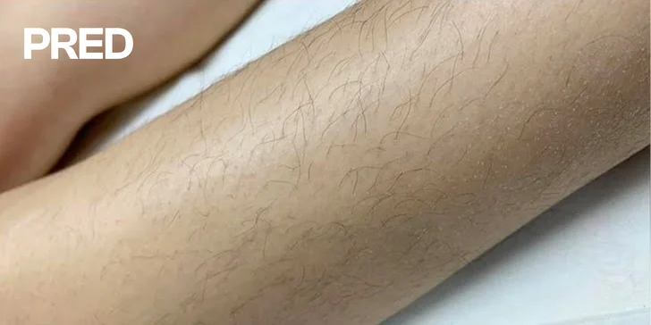 Zbavte sa chĺpkov: Laserová epilácia pre dámy aj pánov