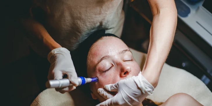 Mezoterapia pomocou dermapenu s jemným chemickým peelingom