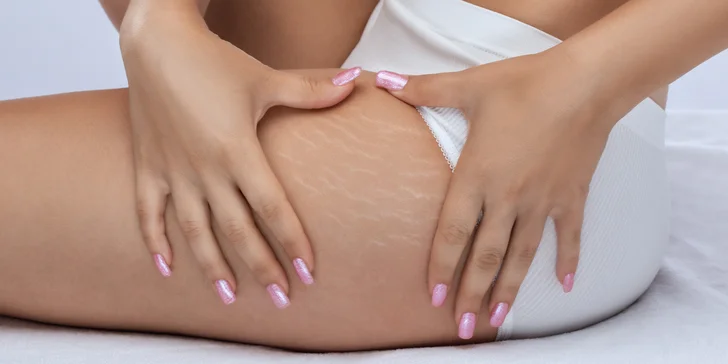 Estetická kamufĺáž strií a jaziev pigmentom alebo kyselinou hyalurónovou