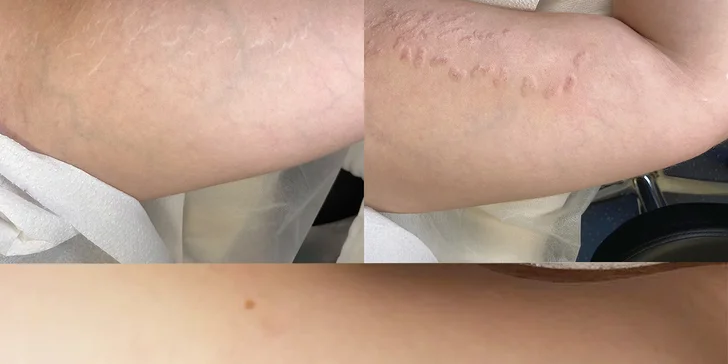 Estetická kamufĺáž strií a jaziev pigmentom alebo kyselinou hyalurónovou