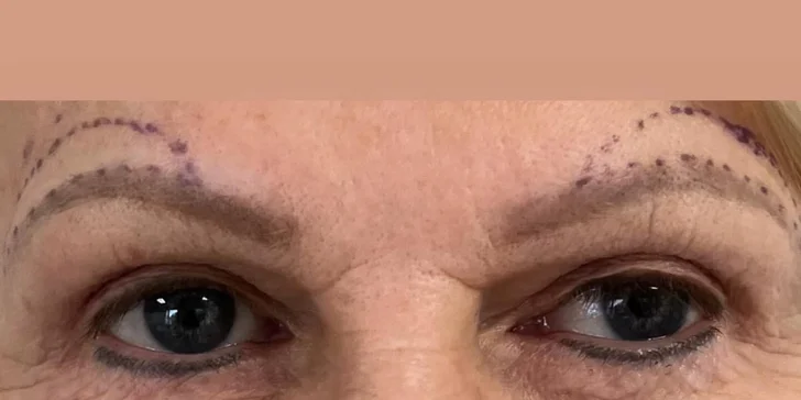 Lifting čela a viečok: Operácia horných viečok alebo Direct browlift s efektom blefaroplastiky