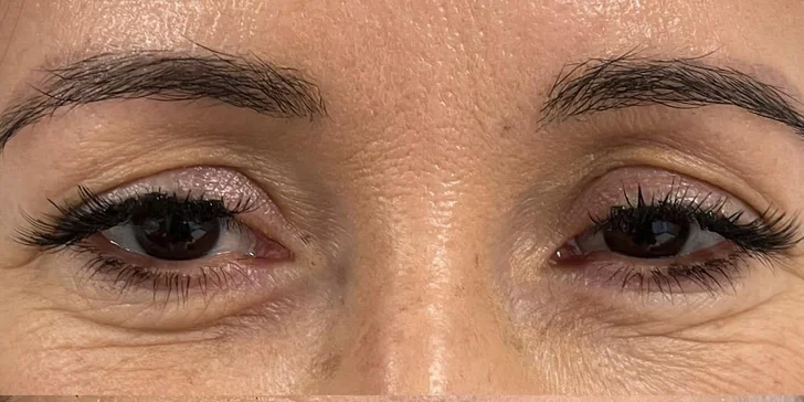 Lifting čela a viečok: Operácia horných viečok alebo Direct browlift s efektom blefaroplastiky