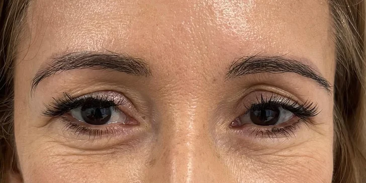 Lifting čela a viečok: Operácia horných viečok alebo Direct browlift s efektom blefaroplastiky