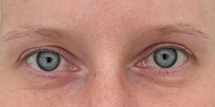 Lifting čela a viečok: Operácia horných viečok alebo Direct browlift s efektom blefaroplastiky