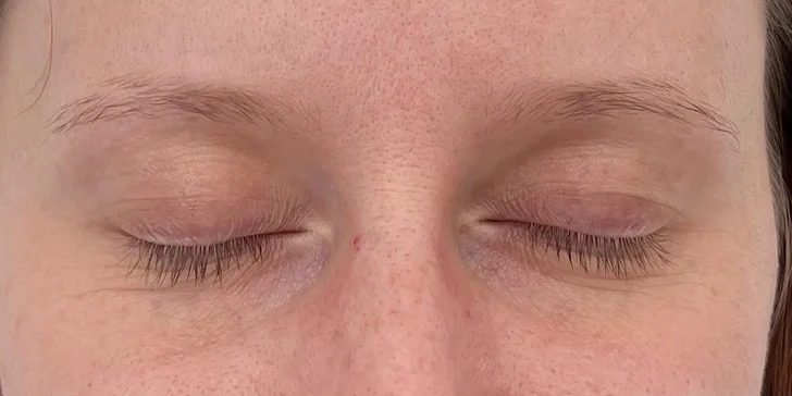 Lifting čela a viečok: Operácia horných viečok alebo Direct browlift s efektom blefaroplastiky