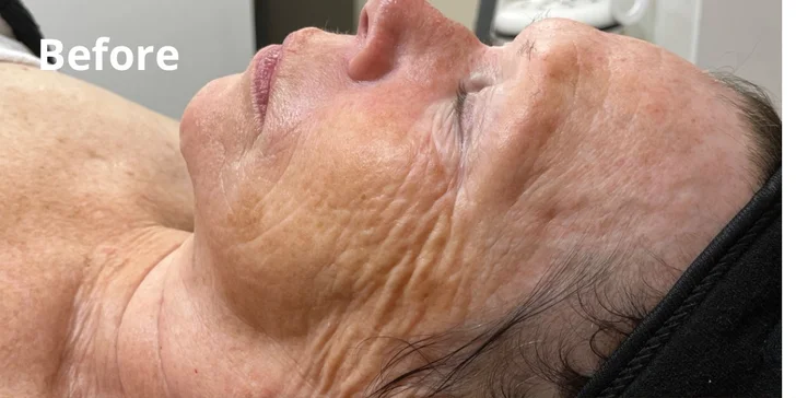 Omladzujúce ošetrenia: Chemický peeling s biopeptidmi, hĺbkové čistenie pleti, rádiofrekvencia, mezoterapia a i.