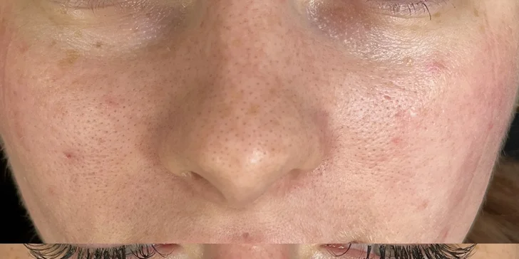 Omladzujúce ošetrenia: Chemický peeling s biopeptidmi, hĺbkové čistenie pleti, rádiofrekvencia, mezoterapia a i.