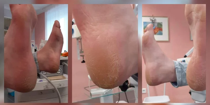 Všetko pre vaše nôžky - Rôzne typy pedikúry, gél lak aj reflexná masáž