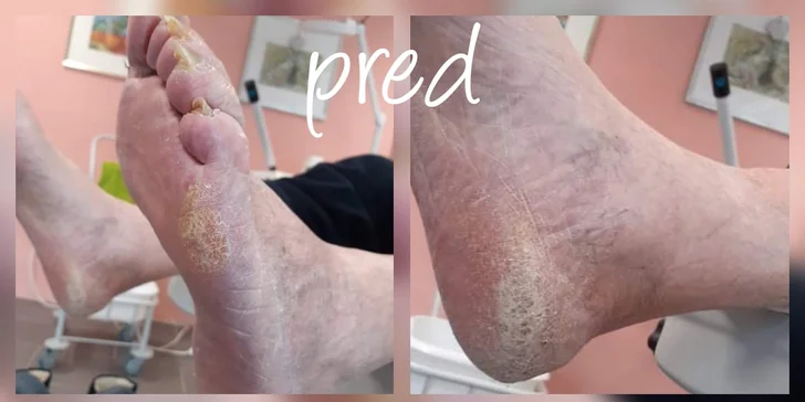 Všetko pre vaše nôžky - Rôzne typy pedikúry, gél lak aj reflexná masáž