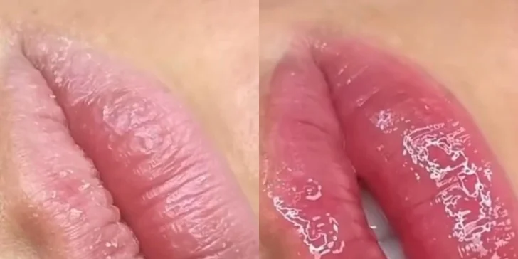 Laminácia, Lash Lift, hydratácia pier alebo mezoterapia dermapenom