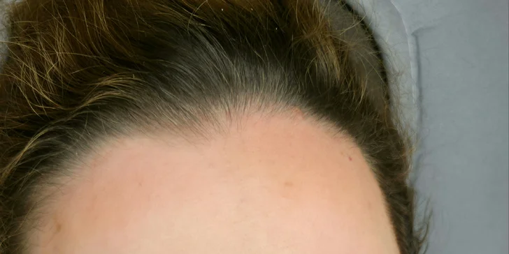 7 techník PMU alebo mezoterapia dermapenom či úprava obočia