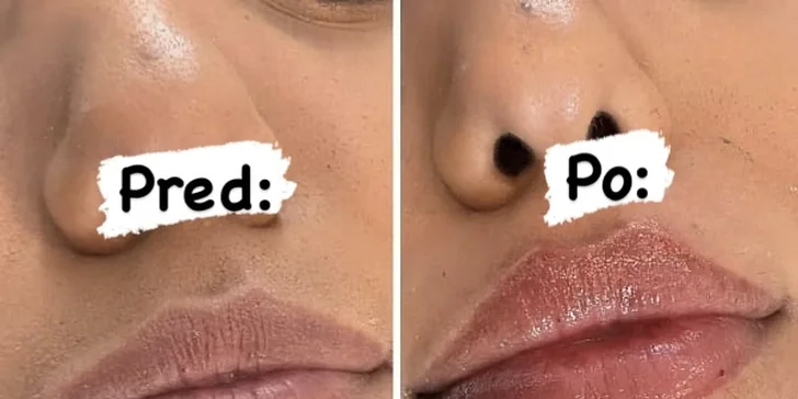 Upravenie, výplň, hydratácia alebo modelácia pier kyselinou hyalurónovou