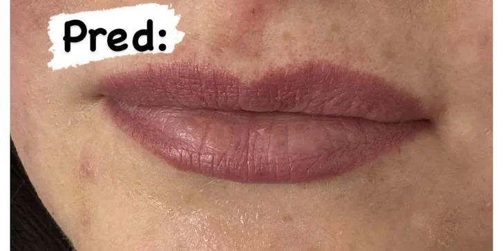 Upravenie, výplň, hydratácia alebo modelácia pier kyselinou hyalurónovou