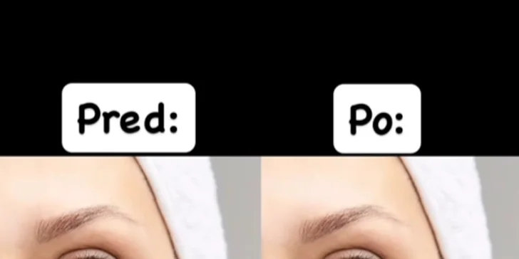 Botulotoxín značky Dysport alebo Baby Botox pre korekciu vrások
