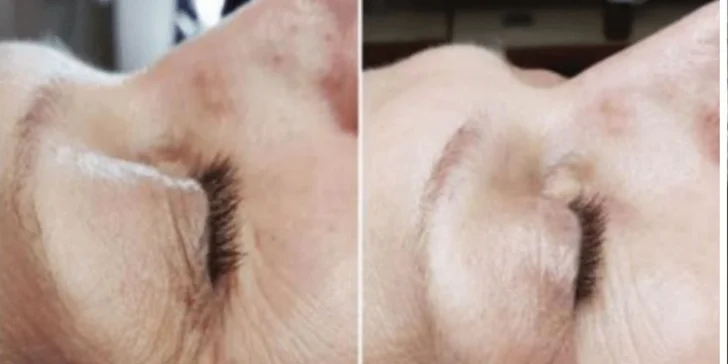 Prémiová biorevitalizácia pleti pomocou lososích spermií