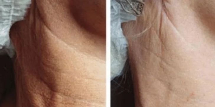 Prémiová biorevitalizácia pleti pomocou lososích spermií
