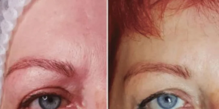 Prémiová biorevitalizácia pleti pomocou lososích spermií
