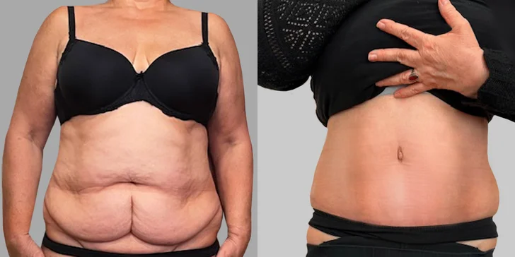 Špičková Aurel Clinic: Zľava na facelift, zubné korunky či prsné implantáty