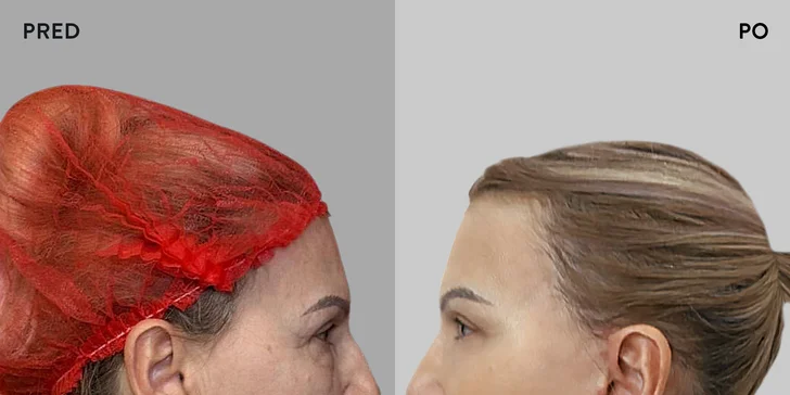Špičková Aurel Clinic: Zľava na facelift, zubné korunky či prsné implantáty