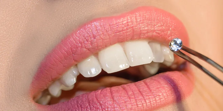 Dentálna hygiena, bielenie zubov alebo štýlový zubný šperk