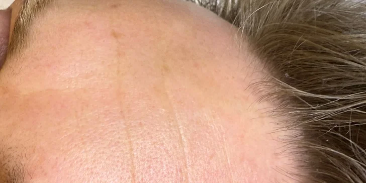 HIFU terapia - neinvazívny lifting pleti v Anzu Cosmetics