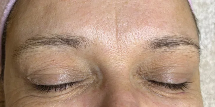 HIFU terapia - neinvazívny lifting pleti v Anzu Cosmetics