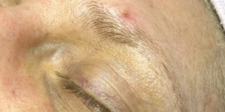 HIFU terapia - neinvazívny lifting pleti v Anzu Cosmetics