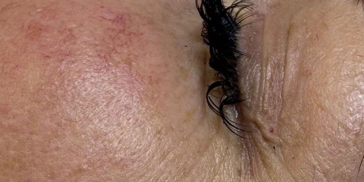 HIFU terapia - neinvazívny lifting pleti v Anzu Cosmetics