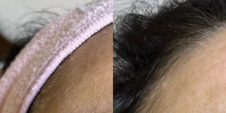 HIFU terapia - neinvazívny lifting pleti v Anzu Cosmetics